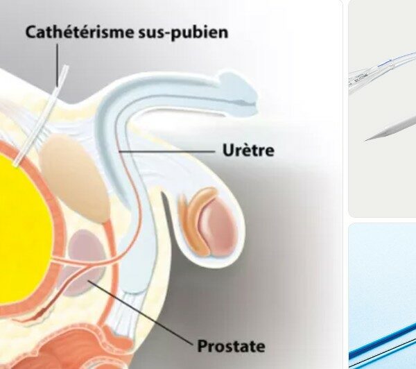 Set de drainage sus-pubien Cystodrain®